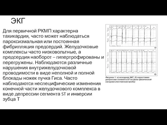 ЭКГ Для первичной РКМП характерна тахикардия, часто может наблюдаться пароксизмальная