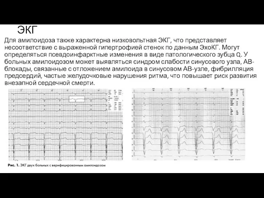 ЭКГ Для амилоидоза также характерна низковольтная ЭКГ, что представляет несоответствие