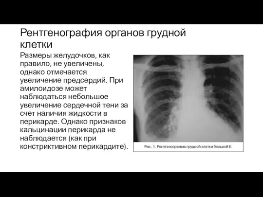 Рентгенография органов грудной клетки Размеры желудочков, как правило, не увеличены,