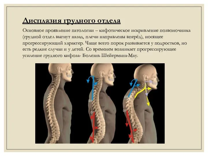 Дисплазия грудного отдела Основное проявление патологии – кифотическое искривление позвоночника