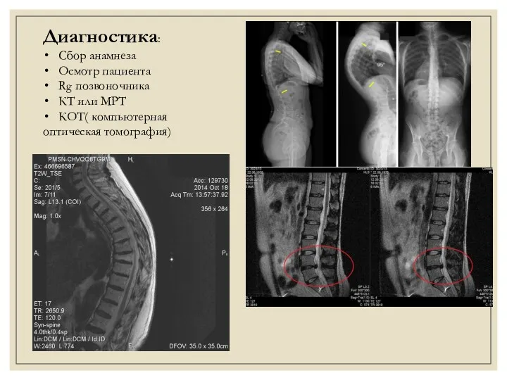 Диагностика: Сбор анамнеза Осмотр пациента Rg позвоночника КТ или МРТ КОТ( компьютерная оптическая томография)
