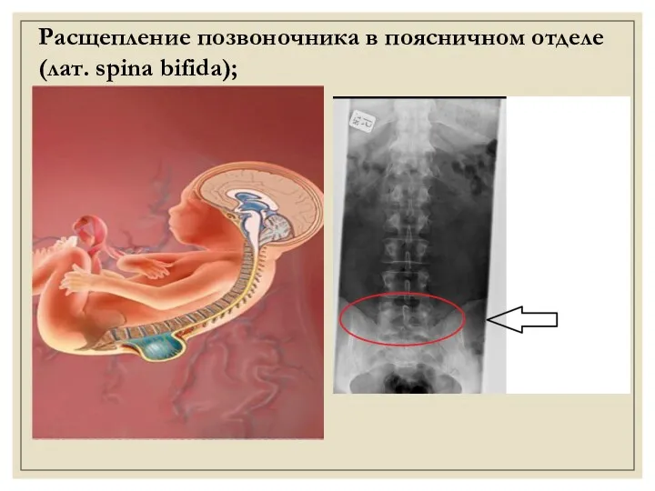 Расщепление позвоночника в поясничном отделе (лат. spina bifida);
