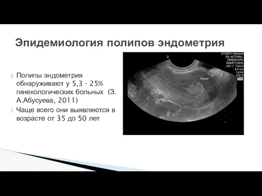 Полипы эндометрия обнаруживают у 5,3 - 25% гинекологических больных (З.А.Абусуева,