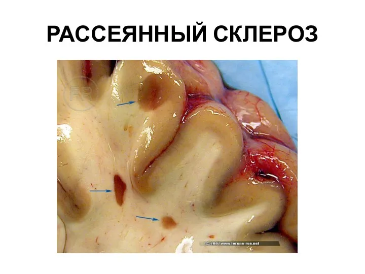 РАССЕЯННЫЙ СКЛЕРОЗ