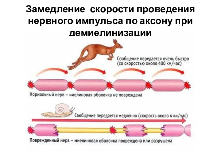 Замедление скорости проведения нервного импульса по аксону при демиелинизации