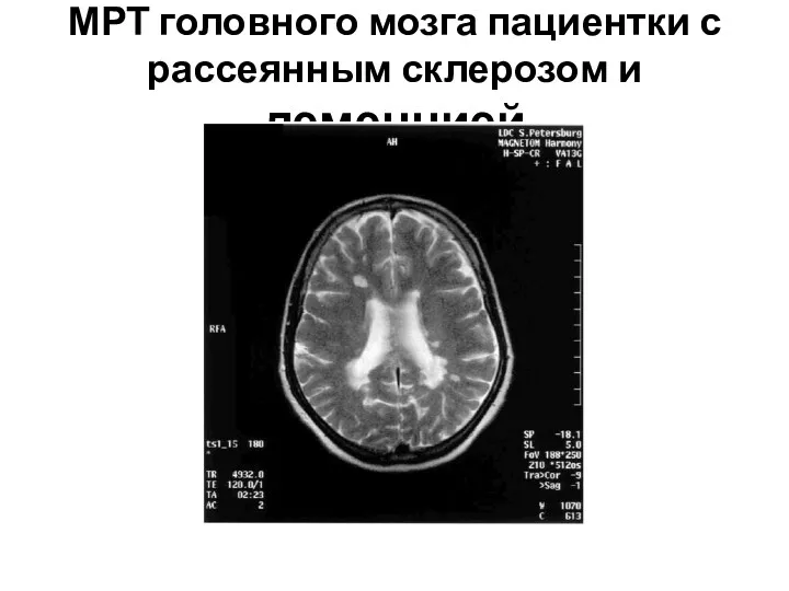 МРТ головного мозга пациентки с рассеянным склерозом и деменцией