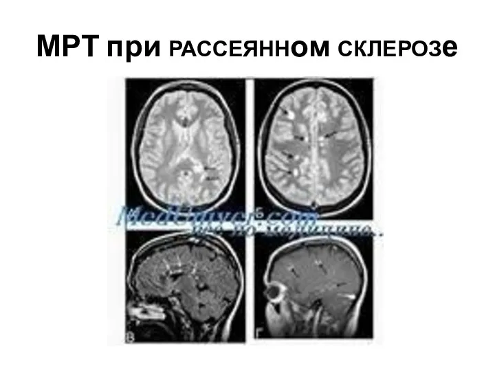 МРТ при РАССЕЯННом СКЛЕРОЗе