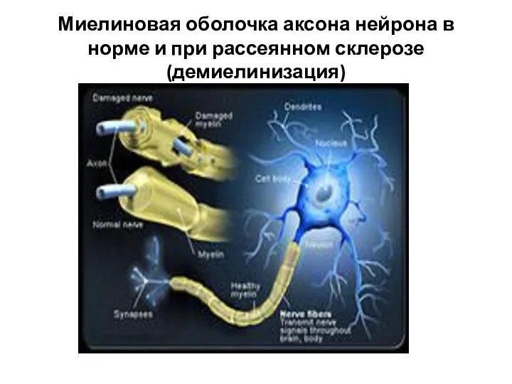 Миелиновая оболочка аксона нейрона в норме и при рассеянном склерозе (демиелинизация)