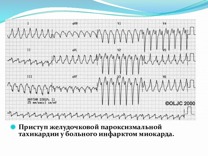 Приступ желудочковой пароксизмальной тахикардии у больного инфарктом миокарда.