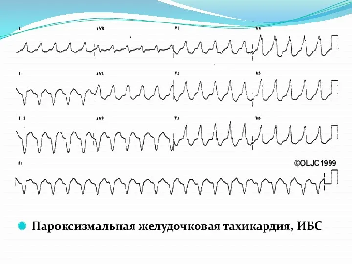 Пароксизмальная желудочковая тахикардия, ИБС