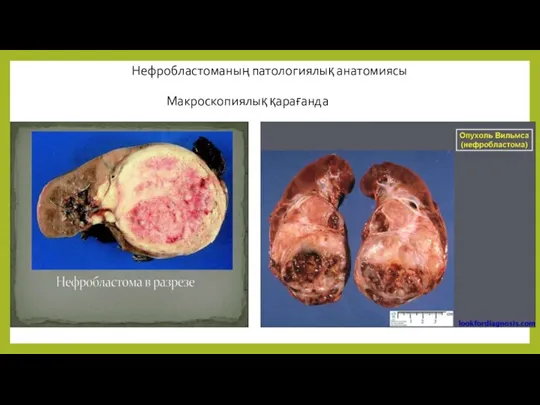 Макроскопиялық қарағанда Нефробластоманың патологиялық анатомиясы
