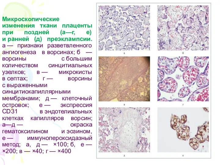 Микроскопические изменения ткани плаценты при поздней (а—г, е) и ранней