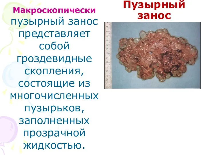 Пузырный занос Макроскопически пузырный занос пред­ставляет собой гроздевидные скопления, состоящие из многочислен­ных пузырьков, заполненных прозрачной жидкостью.