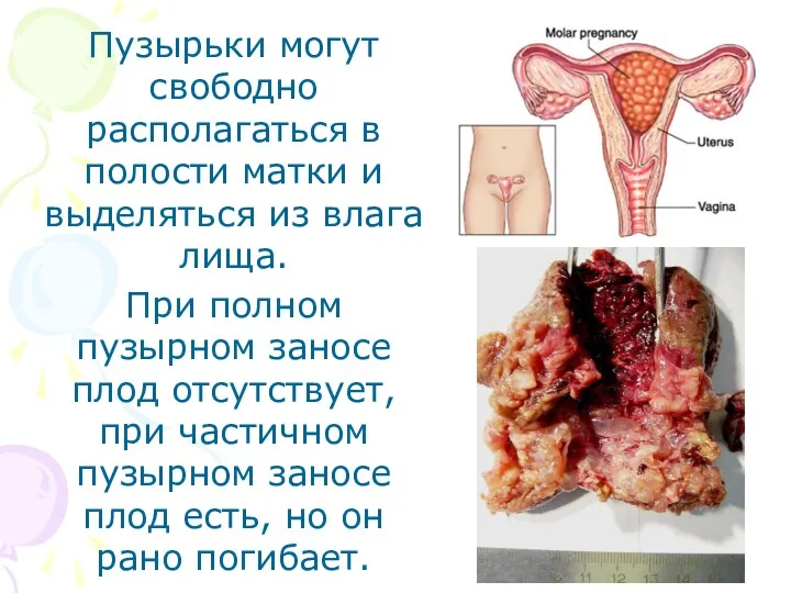 Пузырьки мо­гут свободно располагаться в полости матки и выделяться из