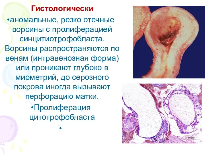 Гистологически аномальные, резко отечные ворсины с про­лиферацией синцитиотрофобласта. Ворсины распространяются