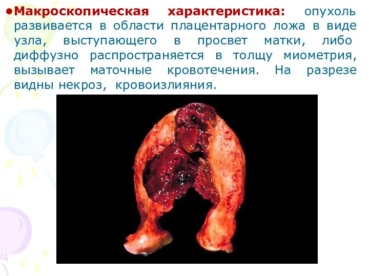 Макроскопическая характеристика: опухоль развивается в области плацентарного ложа в виде