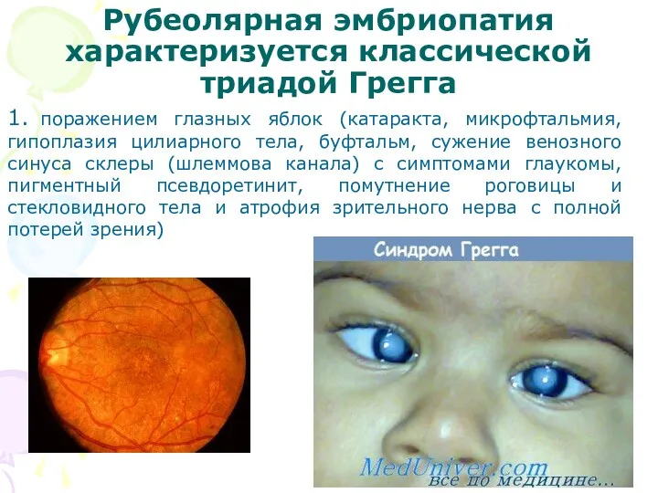 Рубеолярная эмбриопатия характеризуется классической триадой Грегга 1. поражением глазных яблок