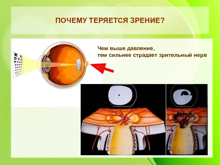 ПОЧЕМУ ТЕРЯЕТСЯ ЗРЕНИЕ? Чем выше давление, тем сильнее страдает зрительный нерв