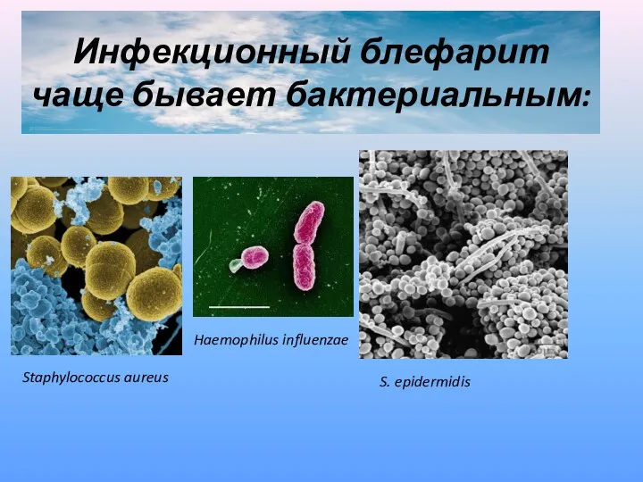 Инфекционный блефарит чаще бывает бактериальным: Staphylococcus aureus Haemophilus influenzae S. epidermidis