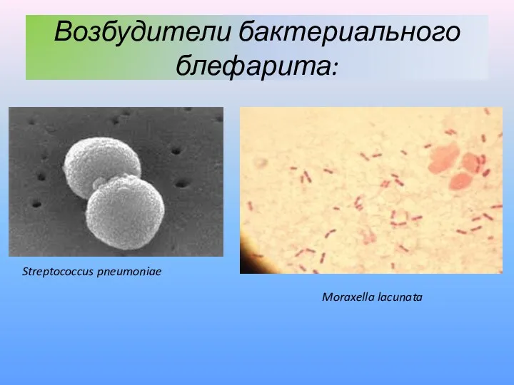 Streptococcus pneumoniae Возбудители бактериального блефарита: Moraxella lacunata