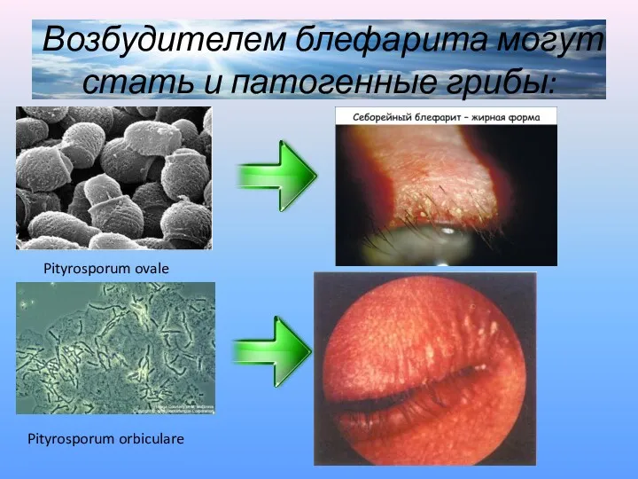 Возбудителем блефарита могут стать и патогенные грибы: Pityrosporum ovale Pityrosporum orbiculare