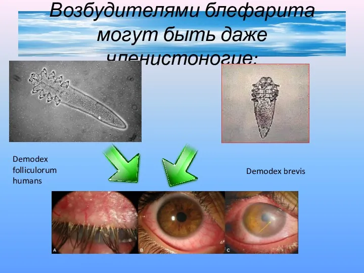 Возбудителями блефарита могут быть даже членистоногие: Demodex folliculorum humans Demodex brevis
