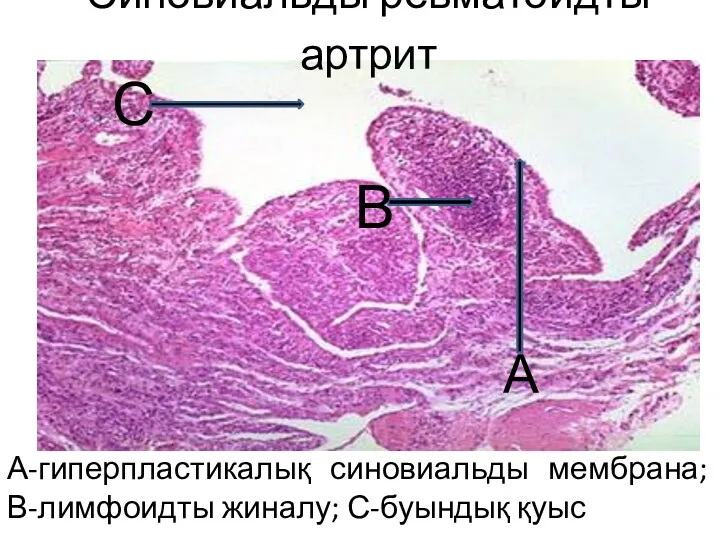 А-гиперпластикалық синовиальды мембрана; В-лимфоидты жиналу; С-буындық қуыс А В С Синовиальды ревматоидты артрит