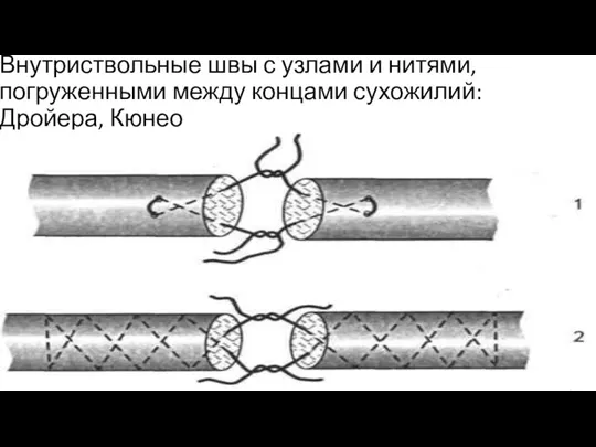 Внутриствольные швы с узлами и нитями, погруженными между концами сухожилий: Дройера, Кюнео