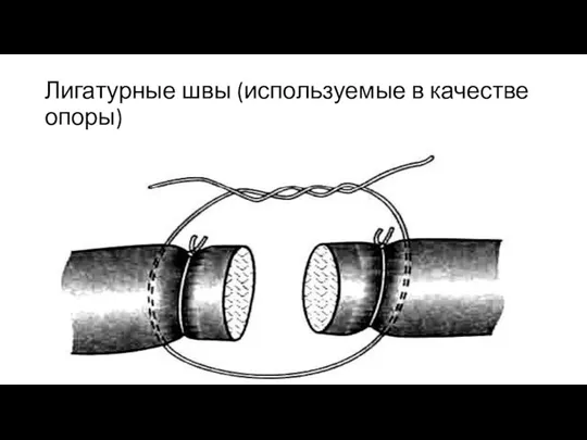 Лигатурные швы (используемые в качестве опоры)