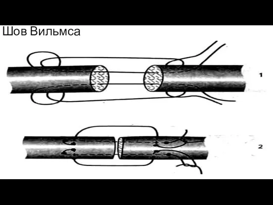 Шов Вильмса