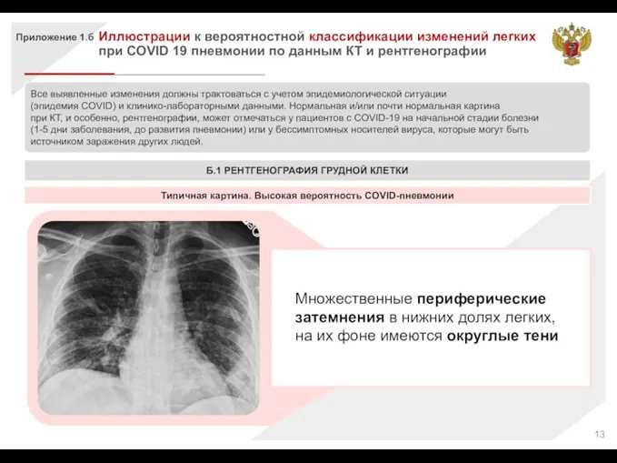 Приложение 1.б Иллюстрации к вероятностной классификации изменений легких при COVID