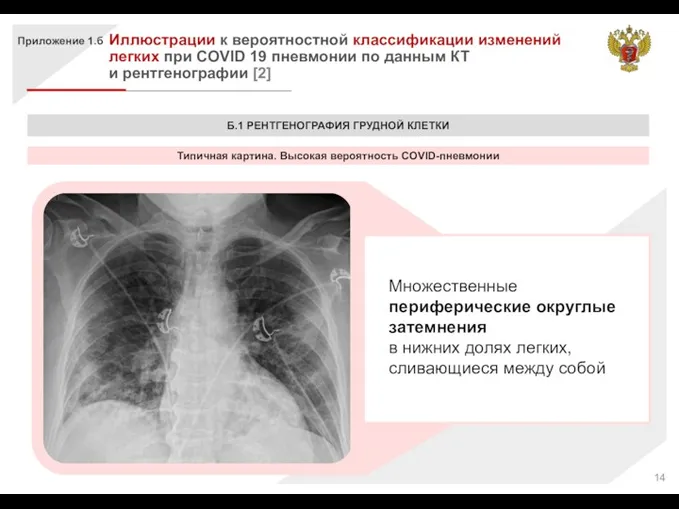 Приложение 1.б Иллюстрации к вероятностной классификации изменений легких при COVID