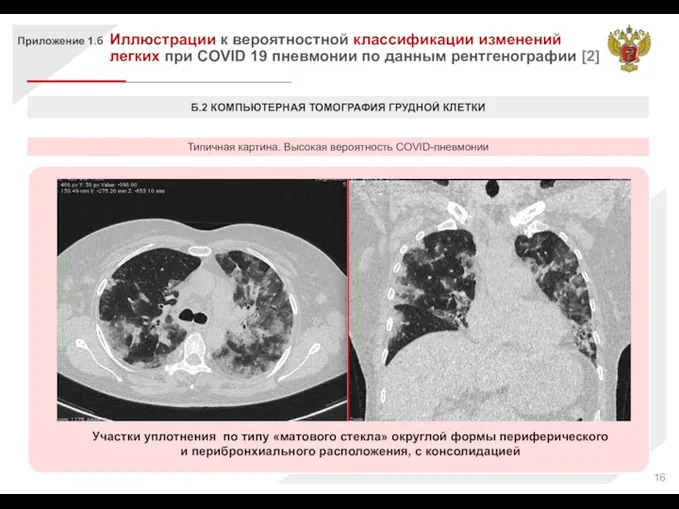 Участки уплотнения по типу «матового стекла» округлой формы периферического и