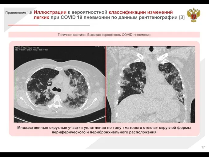 Множественные округлые участки уплотнения по типу «матового стекла» округлой формы