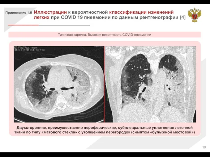 Двухсторонние, преимущественно периферические, субплевральные уплотнения легочной ткани по типу «матового