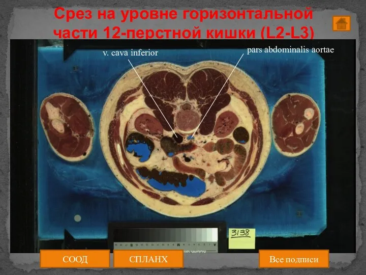 Срез на уровне горизонтальной части 12-перстной кишки (L2-L3) СООД СПЛАНХ Все подписи