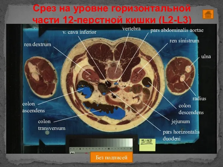 Срез на уровне горизонтальной части 12-перстной кишки (L2-L3) Без подписей