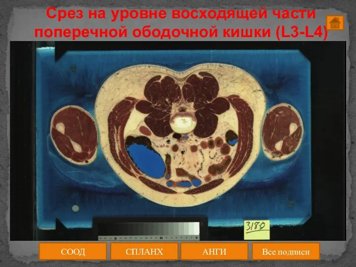 Срез на уровне восходящей части поперечной ободочной кишки (L3-L4) СООД АНГИ СПЛАНХ Все подписи