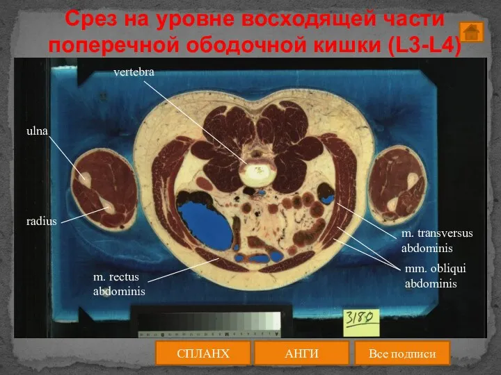 Срез на уровне восходящей части поперечной ободочной кишки (L3-L4) АНГИ СПЛАНХ Все подписи