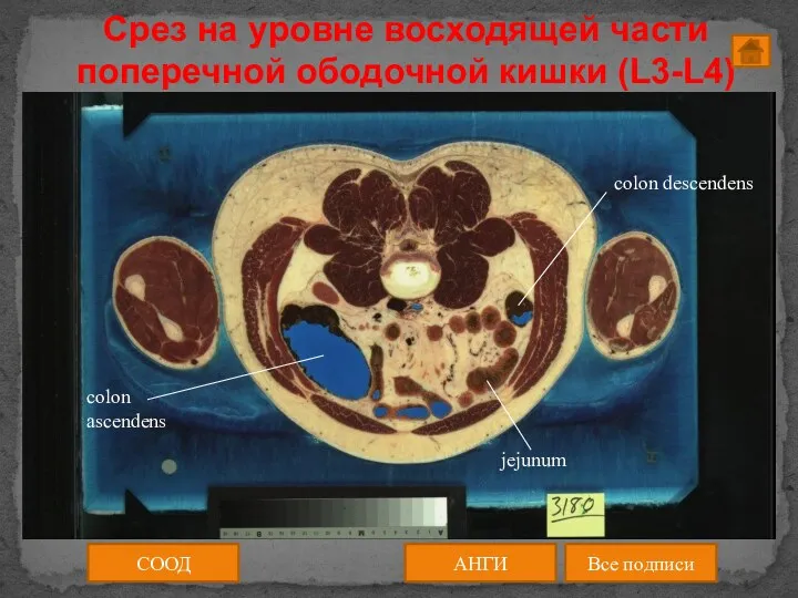 Срез на уровне восходящей части поперечной ободочной кишки (L3-L4) СООД АНГИ Все подписи