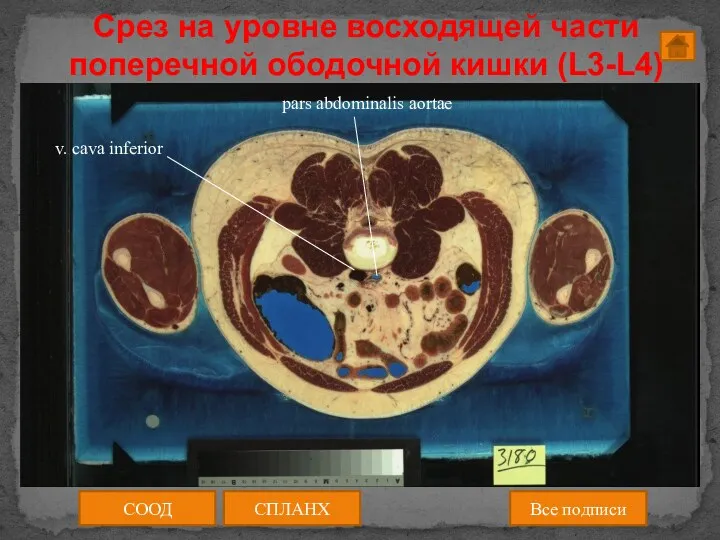 Срез на уровне восходящей части поперечной ободочной кишки (L3-L4) СООД СПЛАНХ Все подписи