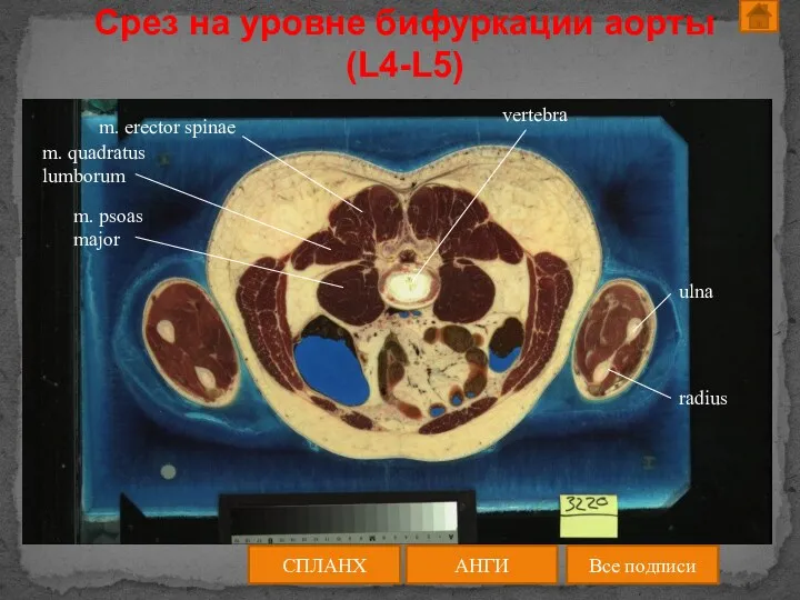 Срез на уровне бифуркации аорты (L4-L5) АНГИ СПЛАНХ Все подписи