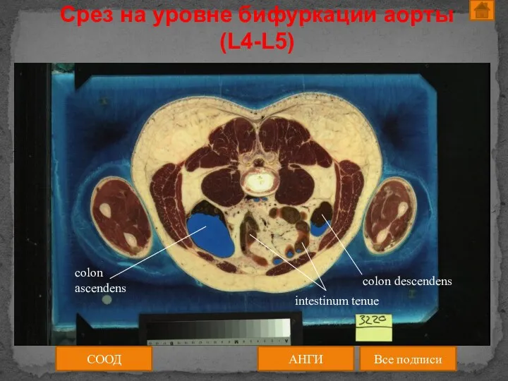 Срез на уровне бифуркации аорты (L4-L5) СООД АНГИ Все подписи