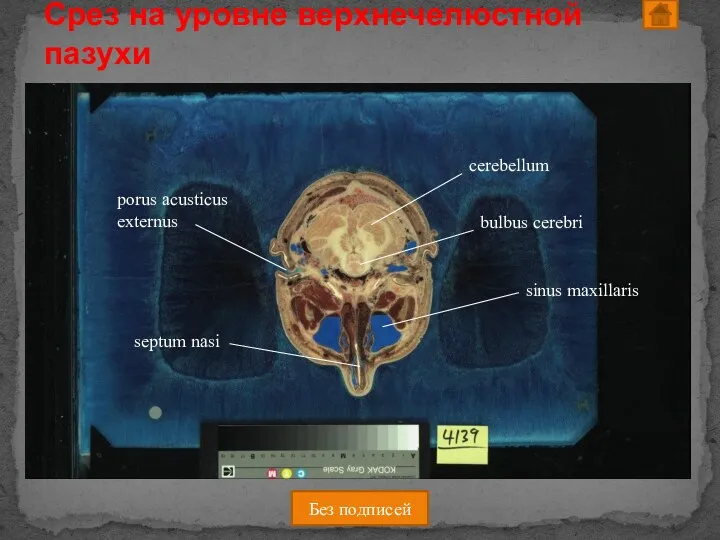 Срез на уровне верхнечелюстной пазухи Без подписей