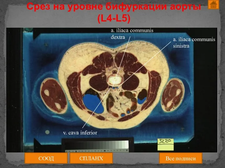 Срез на уровне бифуркации аорты (L4-L5) СООД СПЛАНХ Все подписи