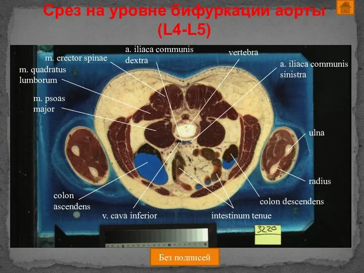 Срез на уровне бифуркации аорты (L4-L5) Без подписей