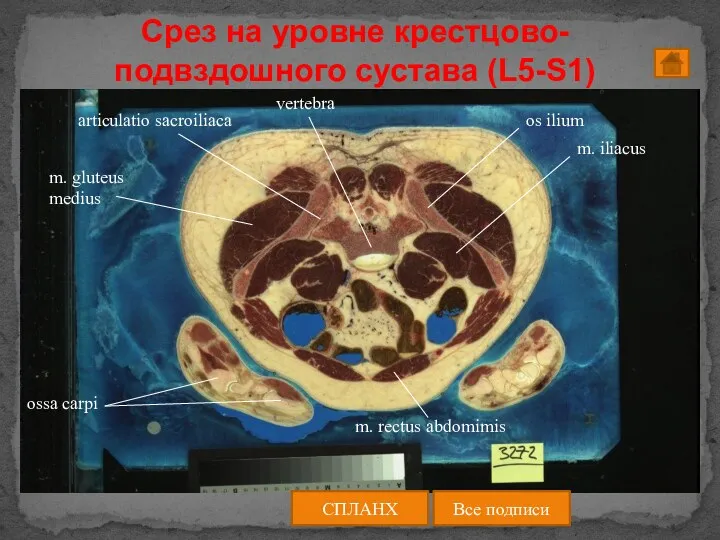 Срез на уровне крестцово-подвздошного сустава (L5-S1) СПЛАНХ Все подписи