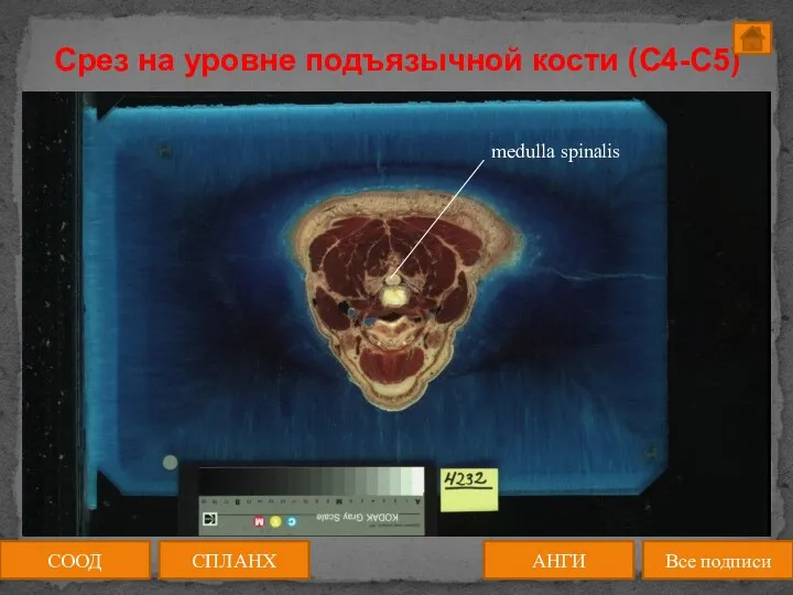 Срез на уровне подъязычной кости (C4-C5) СООД АНГИ СПЛАНХ Все подписи