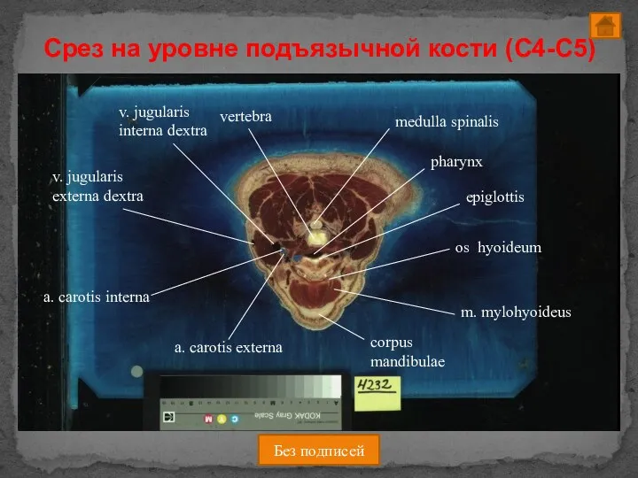 Срез на уровне подъязычной кости (C4-C5) Без подписей