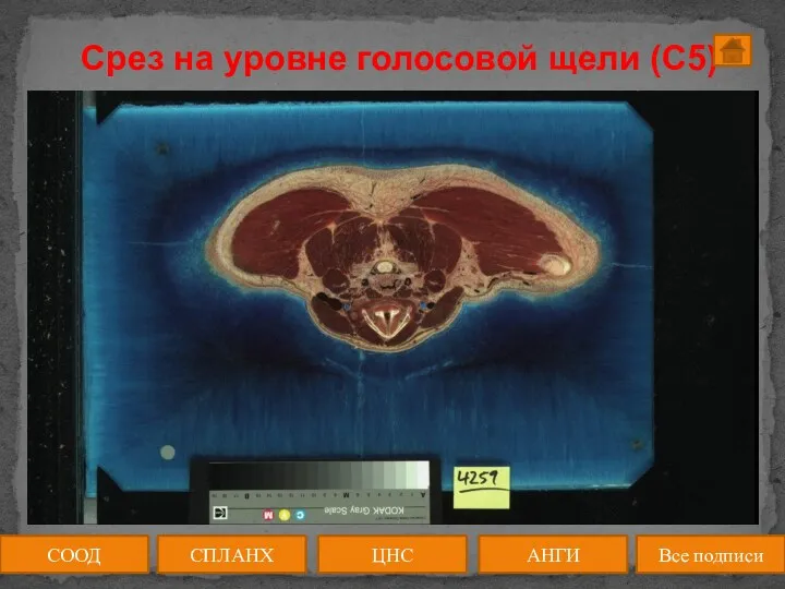 Срез на уровне голосовой щели (C5) СООД ЦНС АНГИ СПЛАНХ Все подписи